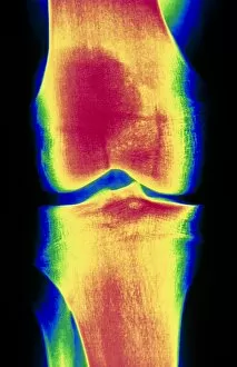 Images Dated 22nd November 1993: Coloured X-ray image of a normal knee-joint