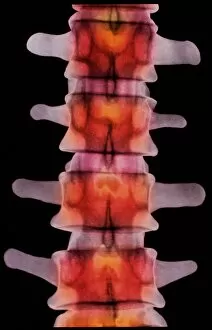 Vertebra Gallery: Coloured X-ray of lumbar vertebrae of the spine