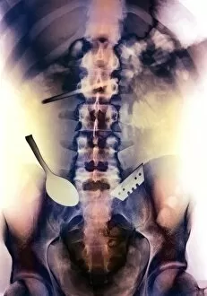 Images Dated 11th February 2003: Coloured X-ray of spoon and blade in intestine