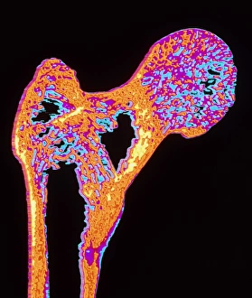 Coloured X-ray of thigh bone with osteoporosis Coloured X-ray of thigh bone with osteoporosis