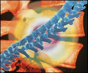 Images Dated 10th August 1998: Computer artwork of a spine depicting back pain