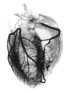 Coronary arteriogram of arteries of the heart 1904 Coronary arteriogram of arteries of the heart 1904