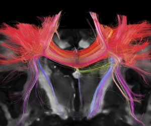 Corpus callosum, DTI MRI scan C017/7043 Corpus callosum, DTI MRI scan C017/7043