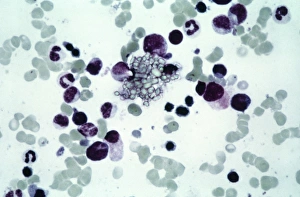 Cystine in bone marrow, light micrograph Cystine in bone marrow, light micrograph