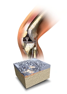 Damaged knee, artwork Damaged knee, artwork