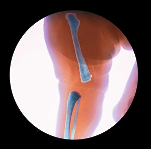 Dislocated knee of baby, X-ray Dislocated knee of baby, X-ray