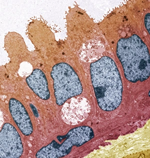 Nuclei Gallery: Ductal breast cancer, TEM