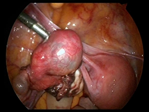 Ectopic pregnancy, endoscope view C017/6804 Ectopic pregnancy, endoscope view C017/6804