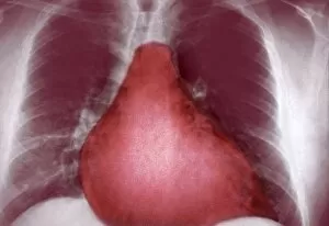 Images Dated 1st December 2004: Enlarged heart, X-ray