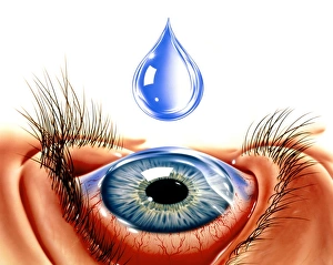Images Dated 13th March 2002: Eye with conjunctivitis
