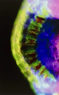 F/col X-ray of thoracic spine in osteoporosis F/col X-ray of thoracic spine in osteoporosis