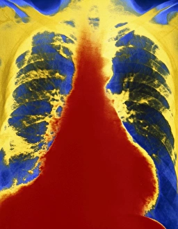 False-col chest x-ray showing hypertension False-col chest x-ray showing hypertension