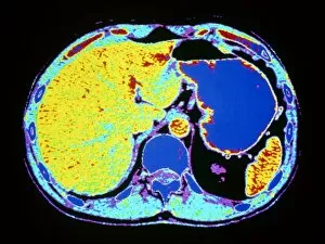 False-colour CT scan of liver & stomach