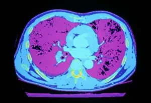 False-colour CT scan of normal heart & lungs