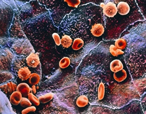 False-colour SEM of blood cells on endocardium False-colour SEM of blood cells on endocardium