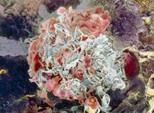 False-colour SEM of human egg surrounded by sperm False-colour SEM of human egg surrounded by sperm