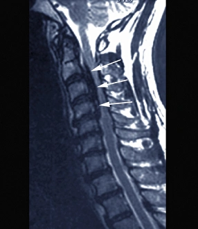 Forestiers disease, MRI scan Forestiers disease, MRI scan