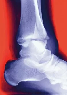 Bones Gallery: Fractured ankle, X-ray