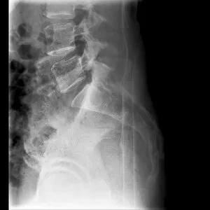 Back Bone Gallery: Fractured vertebra, X-ray C017 / 7585
