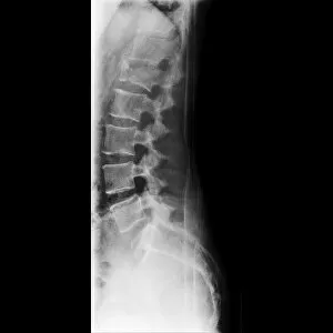 Fractured vertebra, X-ray C017 / 7586