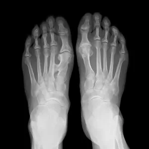 Xray Collection: Fused metatarsals, X-ray C017 / 7168