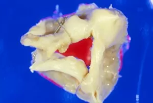 Images Dated 6th September 2002: Gross specimen of stenosed aortic valve