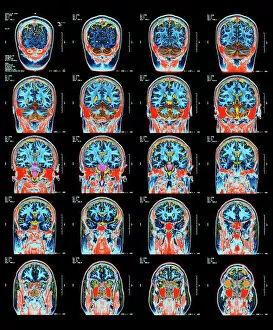 Frontal Gallery: Healthy brain, MRI scans