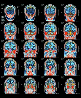 Nervous System Gallery: Healthy brain, MRI scans