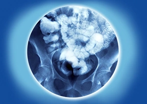 Healthy small intestine, barium enema Healthy small intestine, barium enema