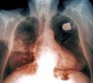 Cardiomegaly Collection | Homeopathic | Best Homeopathic Doctor in Pakistan | Dr Qaisar Ahmed MD, DHMS