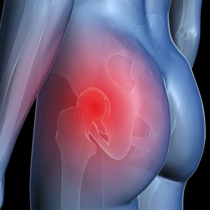 Hip pain, conceptual artwork Hip pain, conceptual artwork