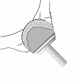 Hip socket bone grafting, diagram C016/6785