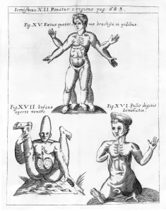 Historical birth deformities Historical birth deformities