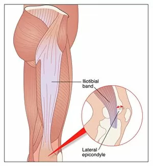 Images Dated 25th March 2011: Iliotibial running injury, artwork