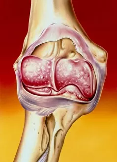 Images Dated 19th November 1991: Illustration of arthritis in elbow joint