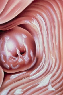 Illustration of candidiasis (thrush) of the cervix Illustration of candidiasis (thrush) of the cervix