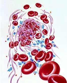 Images Dated 21st April 1994: Illustration of a dissolving blood clot (thrombus)