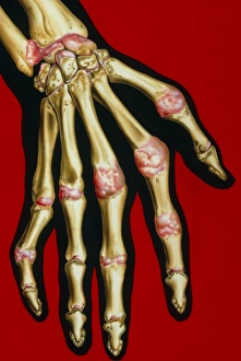 Illustration of rheumatoid arthritis in hand Illustration of rheumatoid arthritis in hand
