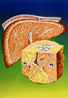 Images Dated 17th April 2003: Illustration of septal cirrhosis of the liver