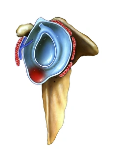 Shoulder Joint Gallery: Infected shoulder capsule, artwork