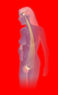 Interstitial cystitis Interstitial cystitis