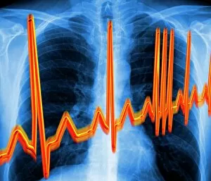 Condition Gallery: Irregular heartbeat