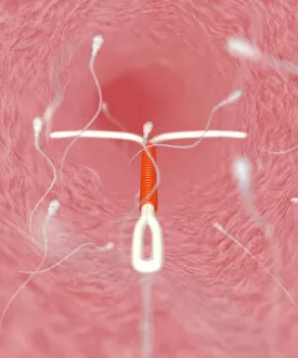 IUD contraceptive and sperm cells