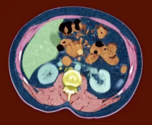 Back Bone Gallery: Kidneys, abdominal CT scan