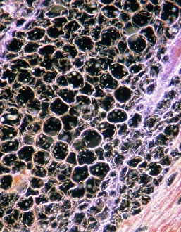 Light micrograph of cardiac muscle & fatty disease Light micrograph of cardiac muscle & fatty disease