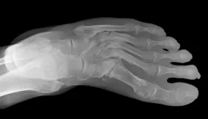 Lisfranc fracture, X-ray