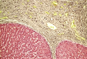 Liver tissue cirrhosis, light micrograph Liver tissue cirrhosis, light micrograph