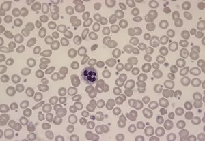 Blood Smear Gallery: LM of blood smear showing iron-deficiency anaemia