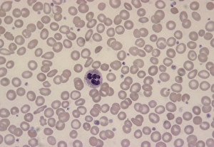 LM of blood smear showing iron-deficiency anaemia LM of blood smear showing iron-deficiency anaemia
