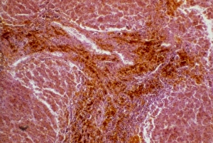 LM of human liver showing alcoholic cirrhosis LM of human liver showing alcoholic cirrhosis